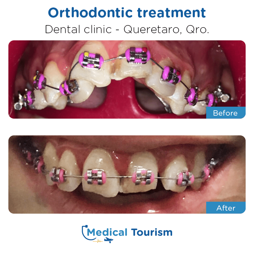 Paciente dentista Querétaro antes y despues
