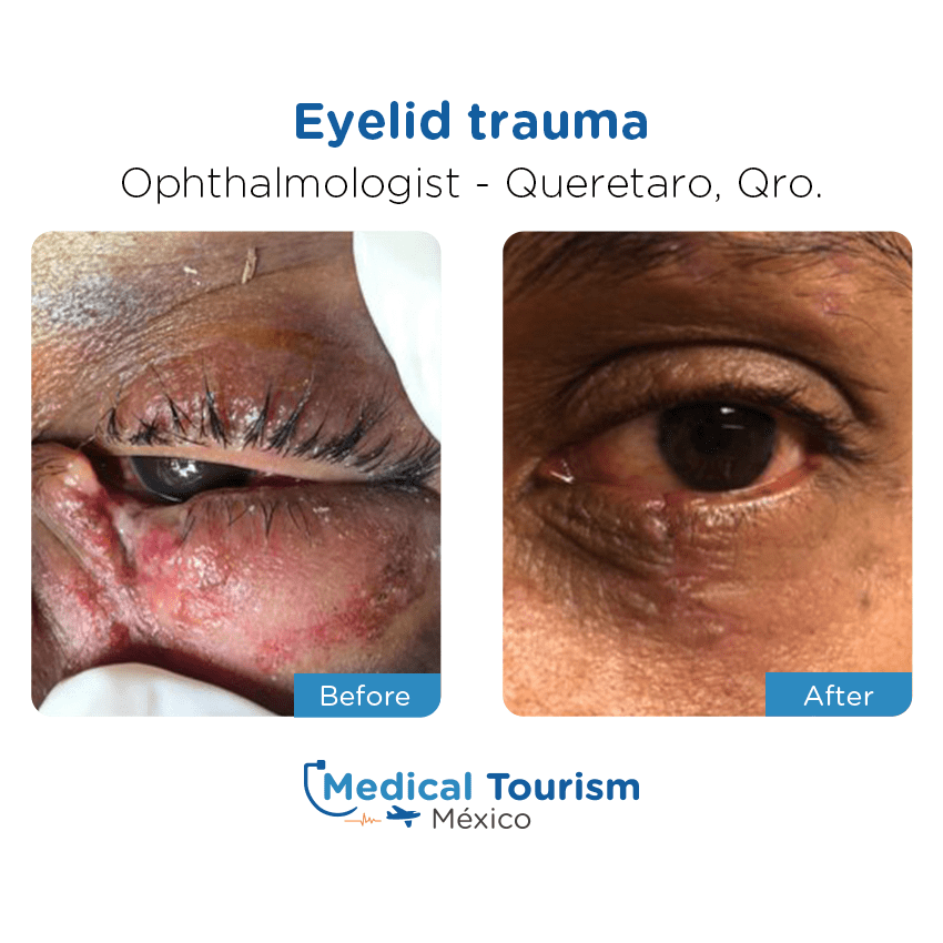 Paciente oftalmología
                                         Querétaro antes y despues