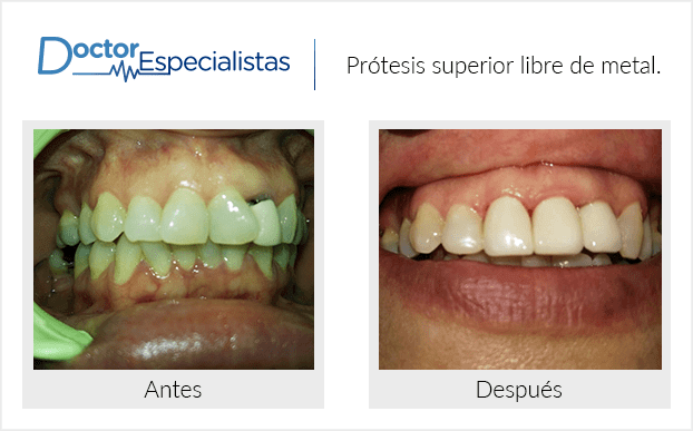 Paciente dentista Tijuana antes y despues