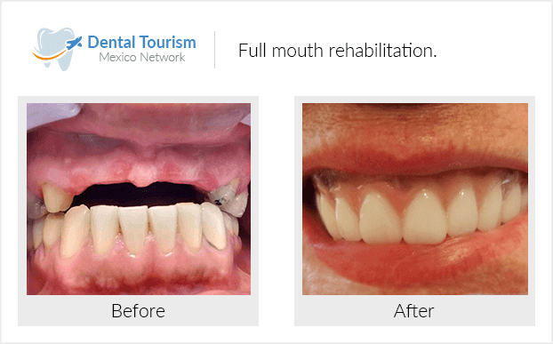 Paciente dentista Tijuana antes y despues