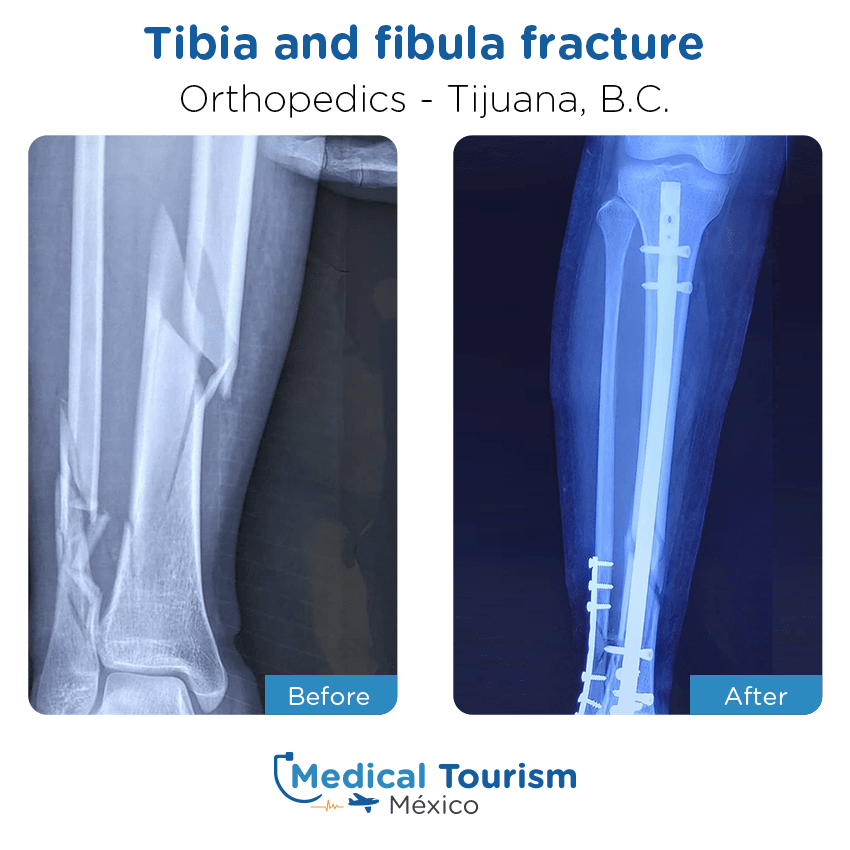 Paciente ortopedia
                                         Tijuana antes y despues